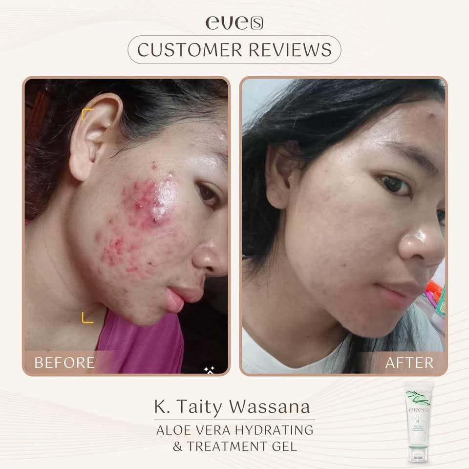 เซทผิวแพ้ง่าย หน้าใส ไร้รอยกวนใจ รูขุมขนกระชับ ผิวอิ่มน้ำฟูเด้ง