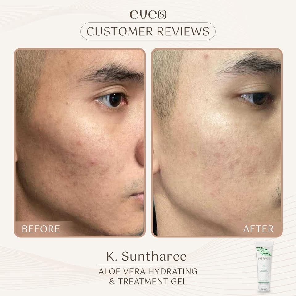 เซทผิวแพ้ง่าย หน้าใส ไร้รอยกวนใจ รูขุมขนกระชับ ผิวอิ่มน้ำฟูเด้ง